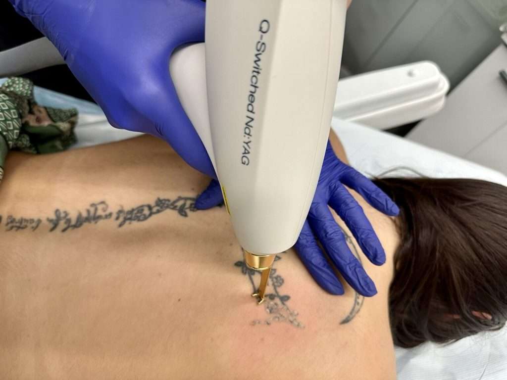 Лазерното премахване на татуировки с Lumenis M22